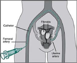 fibroma uterino2