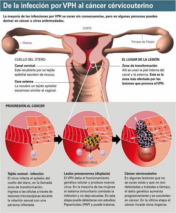 hpv2